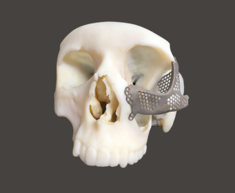 PSI implant
