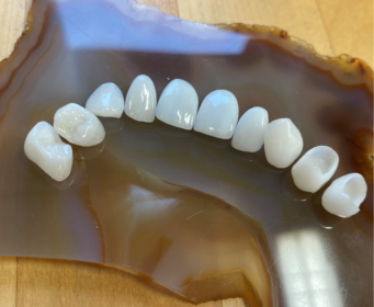 Veneers I.