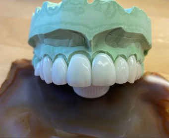 Veneers